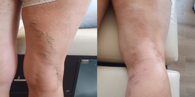Angiologo para tratamiento de varices en Star Medica Queretaro