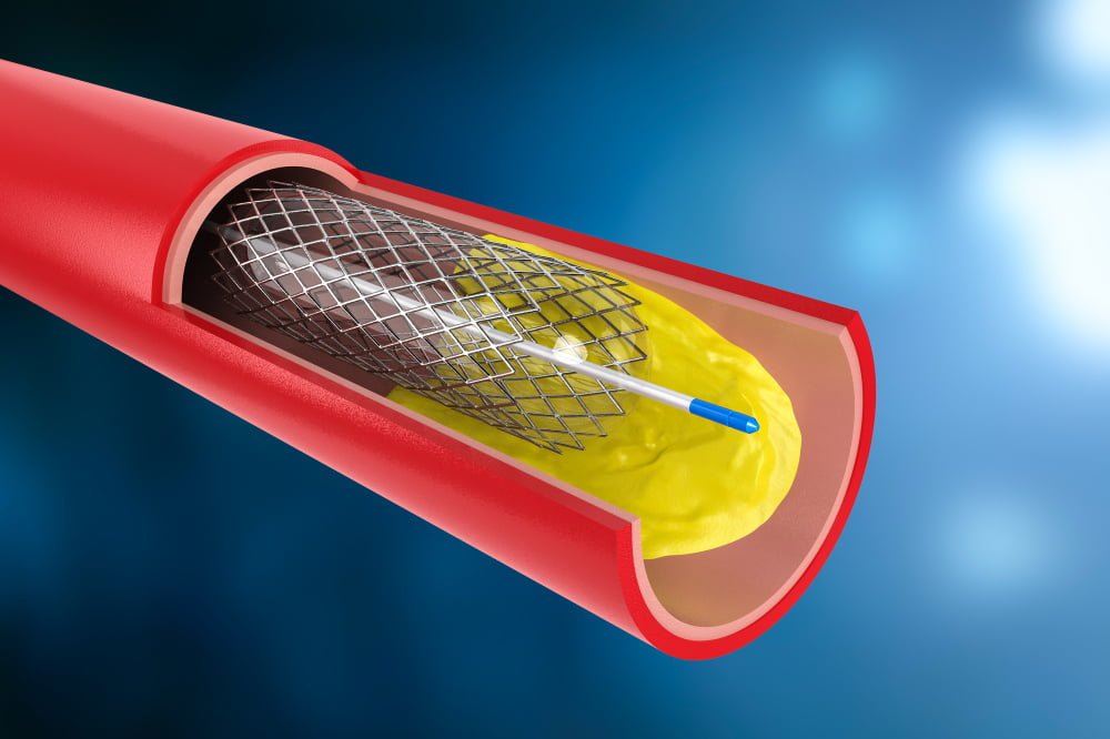 Stent angioplastia para tratamiento de aterosclerosis Queretaro