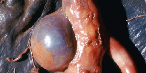 Cirujano vascular para tratar aneurisma Queretaro