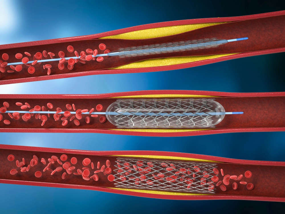 Cirujano vascular para stent aterosclerosis Queretaro