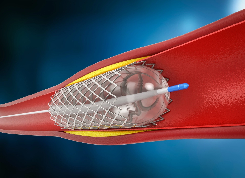 Cirujanos para angioplastia Queretaro